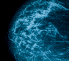 x-ray image of breast density on mammograms