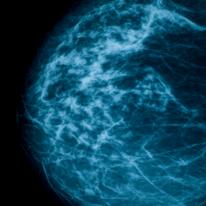 x-ray image of breast density on mammograms