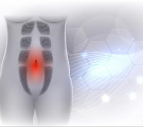 illustration of diastasis recti