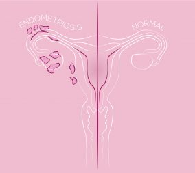 Illustration of endometriosis, endometrial tissue in the uterus,