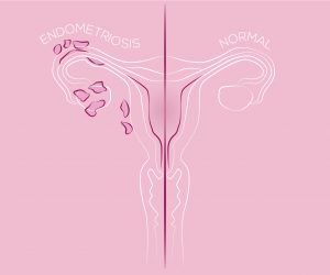 Illustration of endometriosis, endometrial tissue in the uterus,