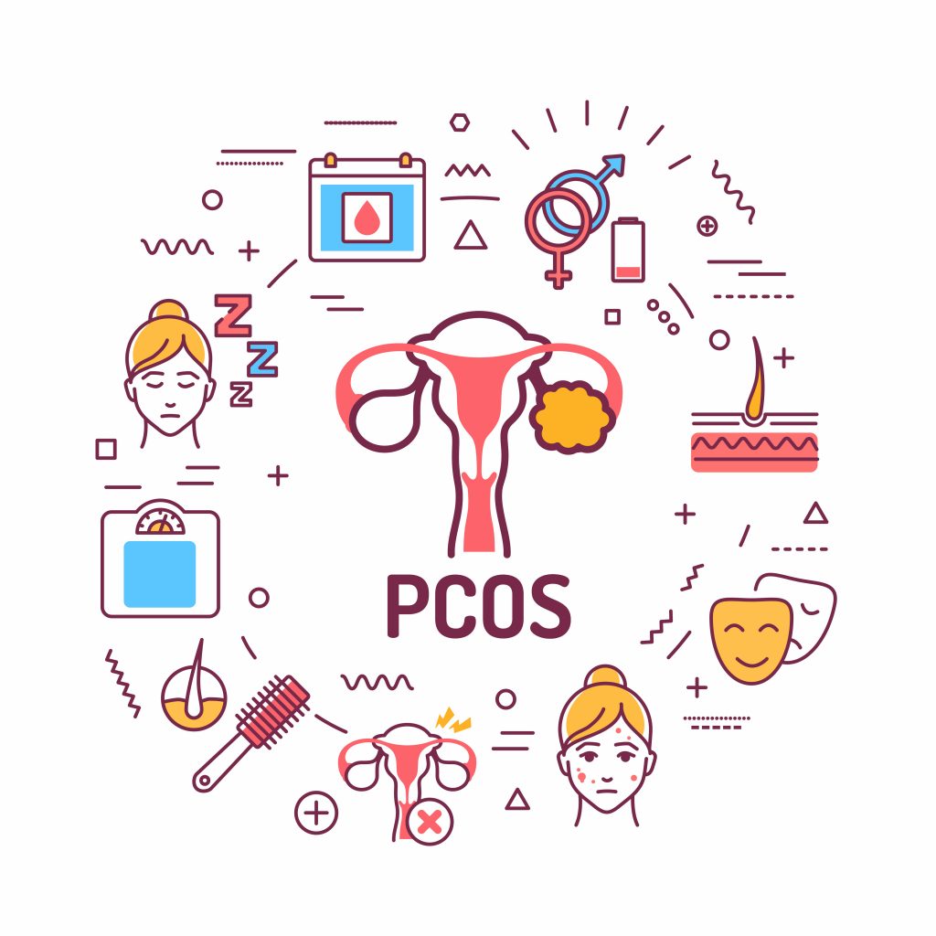 Polycystic ovary syndrome infographic